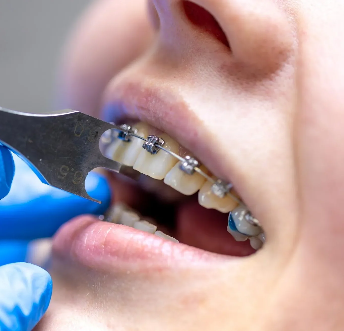 Orthodontic Treatment in howrah